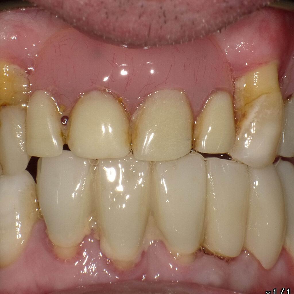 Metamorfoza pacjenta - efekt leczenia implantami
