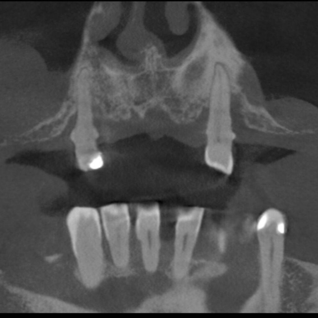 Metamorfoza pacjenta - nowy uśmiech