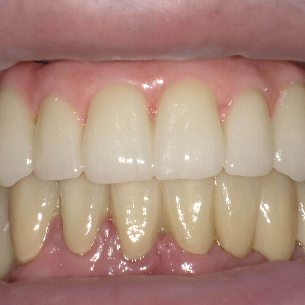 Efekt leczenia bezzębia