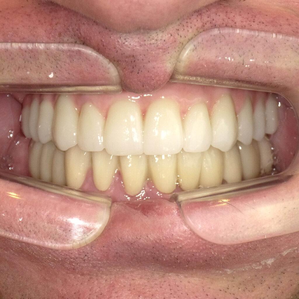 Metamorfoza - implanty zębowe