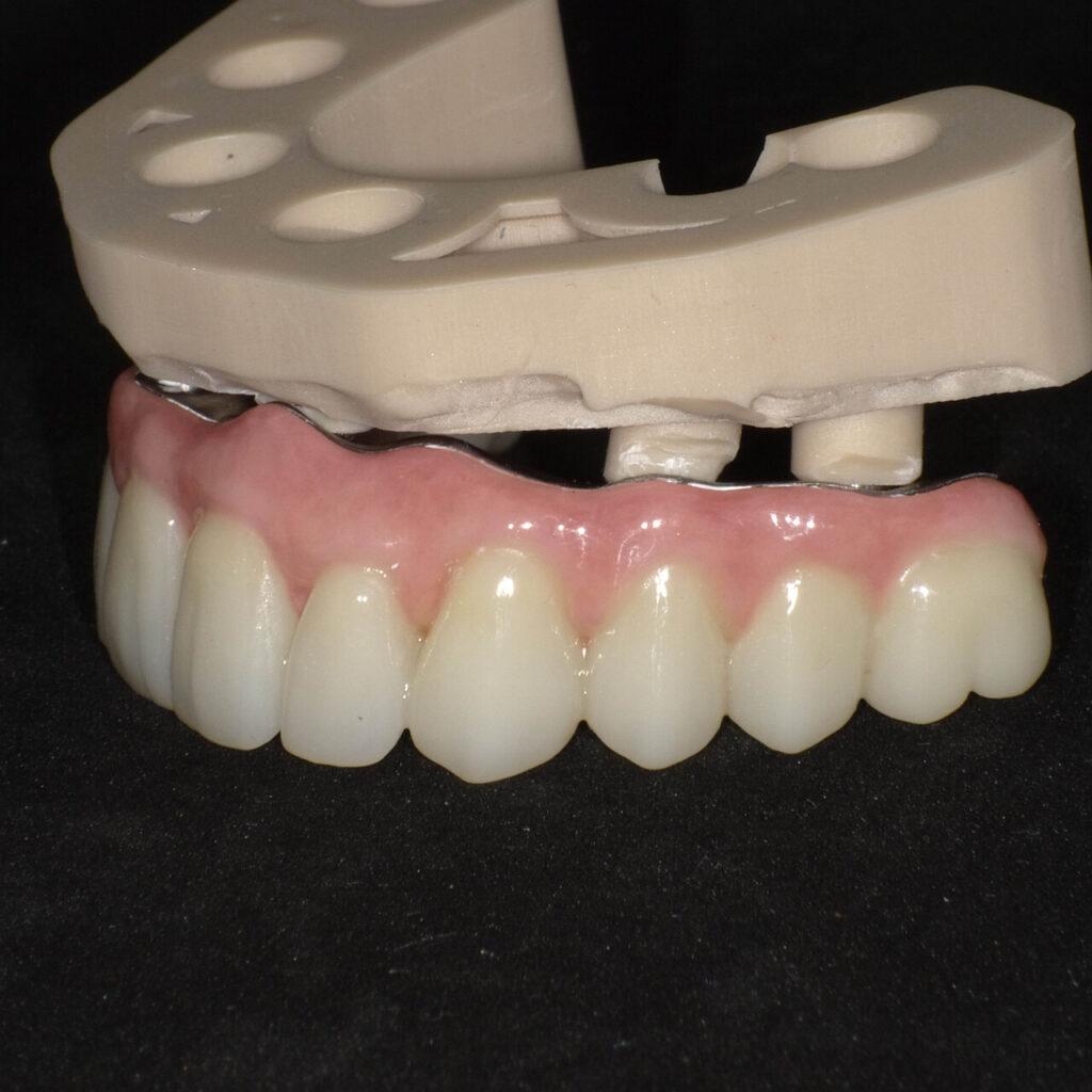 Efekt leczenia - nowe zęby