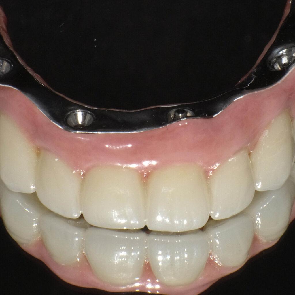 Metamorfoza - zęby na implantach