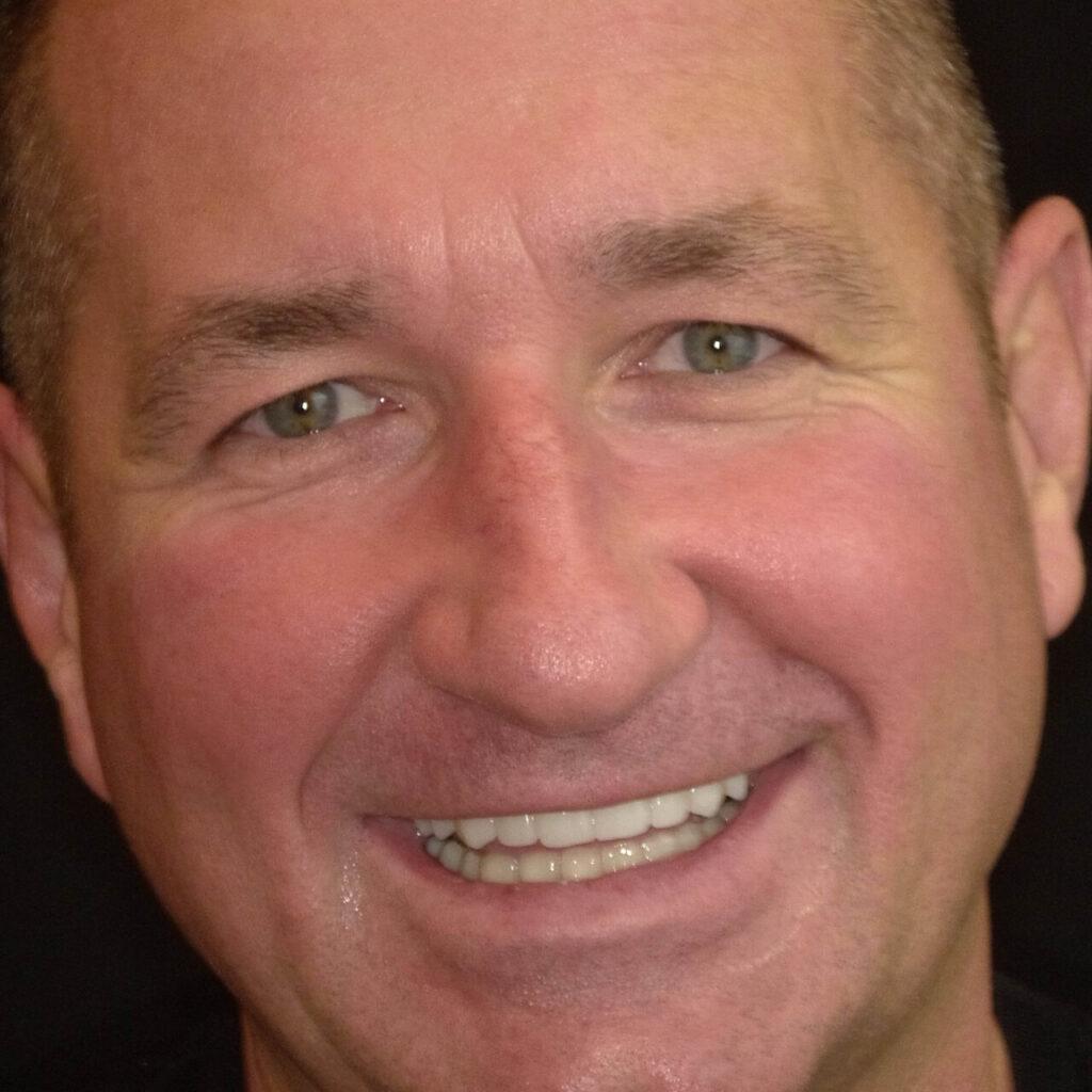 Metamorfoza - odbudowa uśmiechu