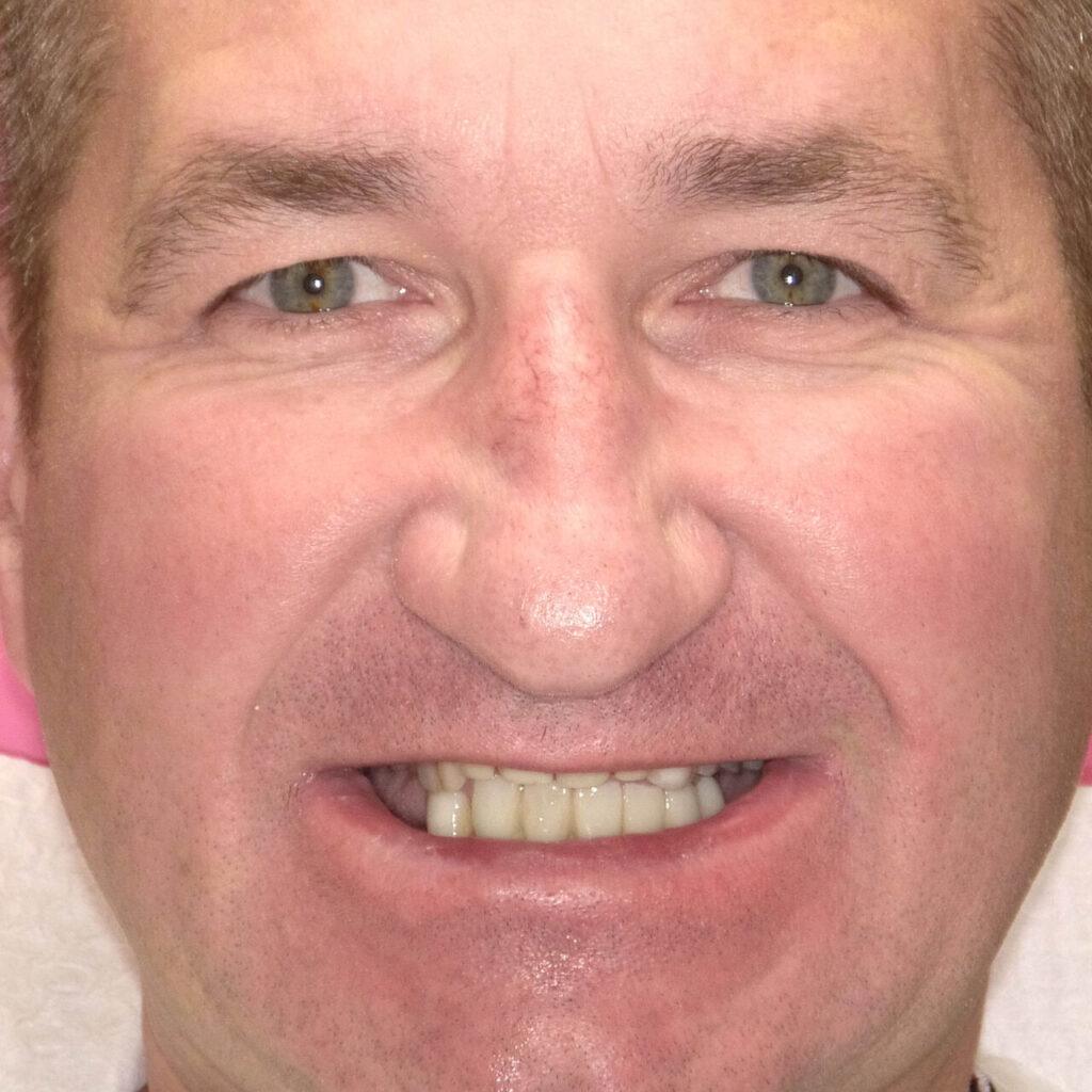 Metamorfoza - leczenie bezzębia